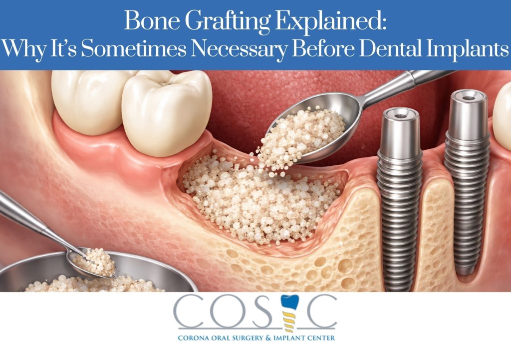 Bone Grafting Explained Why It’s Sometimes Necessary Before Dental Implants
